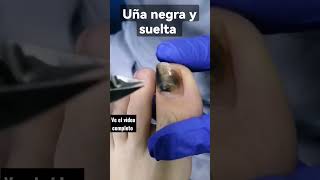 uña negra desprendida podologia uñanegra nails nailsgrowth uñaslargas uñas podologo [upl. by Hgielac]