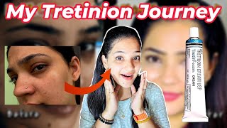 How RetinolTretinoin Transformed my Skin in just 2 Months A MustSee Indian YouTuber Anmol [upl. by Celik759]