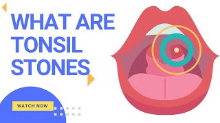 What are Tonsil Stones Tonsillolith How to treat them [upl. by Lyrret]