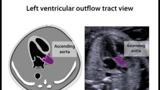 Left Ventricular Outflow Tract View 119 [upl. by Ynabla560]