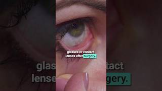 LASIK Complications What You NEED to Know [upl. by Hussey109]