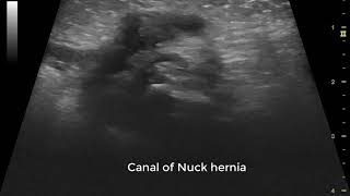 Ultrasound showing hernia of canal of Nuck inguinal hernia in 25 days old girl [upl. by Sutphin]