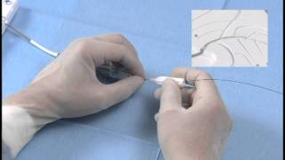 Angioplasty technique manipulation of a guide wire [upl. by Oralle]