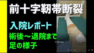 前十字靭帯断裂 入院レポート 手術～退院までの足の様子 （ACL）日記 前十字靭帯損傷断裂 腫れ ムクミ リハビリ ケガ じん帯 前十字靭帯損傷 手術 [upl. by Amilas308]