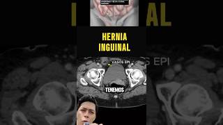 Hernia inguinal directa vs indirecta medicina cirugiageneral cirugia radiologia [upl. by Yecad]