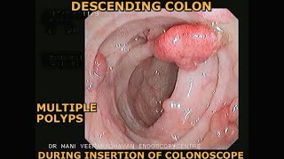 COLON POLYPS  COLONOSCOPY SHOWS MULTIPLE POLYPS  FAMILIAL ADENOMATOUS POLYPOSIS FAP [upl. by Lesya155]