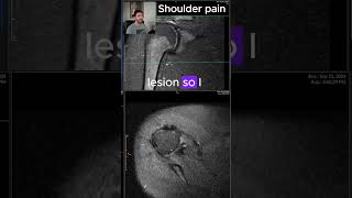 Glenoid labrum tear  MRI SCANS Ep 5 medicalimaging mriscan radiology shoulderpain [upl. by Steel]