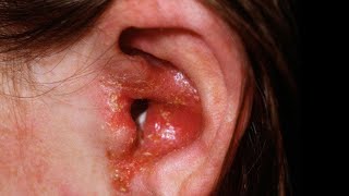 Acute Ear Inflammation  Otitis Externa  What is the Symptoms and treatment [upl. by Feliks]