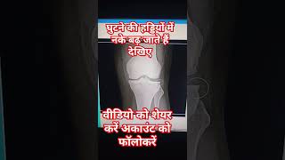 knee joint X Ray osteophytic changes youtuber youtubeshort youtubevideo youtubviralvideo [upl. by Neala]