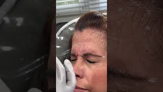 Botox for the glabella area It’s important to animate to see muscle movement prior to injecting [upl. by Mail]