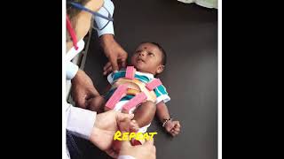 How to wear Pavlik harness in a child with hip problem [upl. by Llehsar]