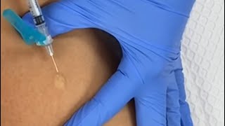 How To Give an Intradermal Injection  PPD  TB Test  Medical Assisting [upl. by Alyacim22]