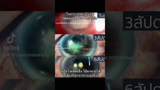 neurotrophic keratitis [upl. by Atilegna813]