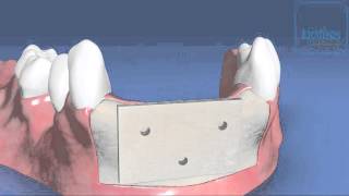 maxgraft® cortico Allogenic bone plates from Botiss [upl. by Anivlem]