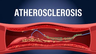 Atherosclerosis animation understanding Atherosclerosis [upl. by Atiuqes785]