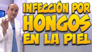 INFECCIÓN POR HONGOS EN LA PIEL  Todo lo que necesita saber [upl. by Lothair]