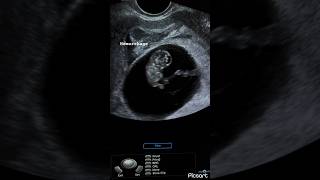 8 weeks fetus subchorionic hemorrhage peri sac hematoma ultrasound ardms sonography radiology [upl. by Eng]