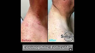 Eosinophilic Folliculitis [upl. by Yajeet]