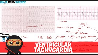 Rate and Rhythm  Ventricular Tachycardia [upl. by Marrin]