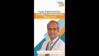 What Is Hypopigmentation  Dr Ravichandran G [upl. by Ferna]