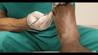 My Hammer Toe Surgery Experience Vlog Telling You About Pre Op Surgery Day amp Post Op Graphic [upl. by Shea]