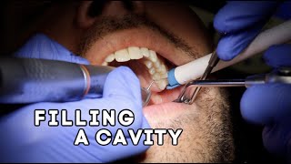 How Does A Dentist Fill A Cavity [upl. by Sprage]