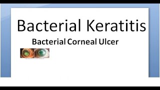 Ophthalmology 111 a Bacterial Keratitis Corneal Ulcer Cornea Bacteria Infective Hypopyon infection [upl. by Valenta260]