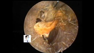 Regular reexamination of cholesteatoma of middle ear after operation [upl. by Yentrok]