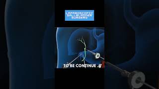 Laparoscopic gallbladder surgery animation shorts [upl. by Ailegnave404]