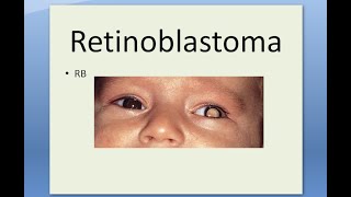 Pathology 509 a Retinoblastoma Eye Tumor Retina Child Flexner WinterSteiner Home Wright Rosette [upl. by Esinnej]