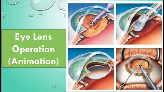 How to treat human eye lens animation [upl. by Inerney523]