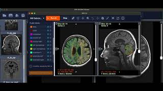 Automated Brain Measurements with AI  IMV Subcortical [upl. by Nylra709]