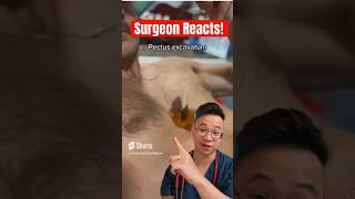 Surgeon Reacts To Human Tea Pot Pectus Excavatum medicine doctor surgeon [upl. by Basset]