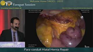 Paraconduit Hiatal Hernia Repair [upl. by Ahsaetal701]