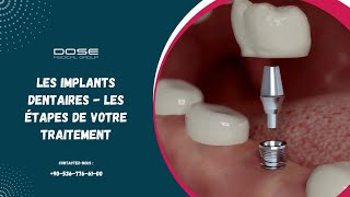 Implants dentaires  Les différentes étapes de votre traitement [upl. by Nivag]