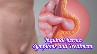 Inguinal hernia I Symptoms and Treatment I हर्निया क्या है DrAshishSachan [upl. by Nazay]