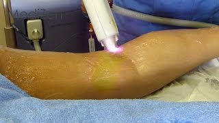 Laser Hair Removal at MediZen Clinic in Birmingham for legs face and body [upl. by Nakah]