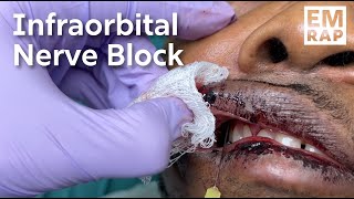 Infraorbital Nerve Block [upl. by Noraha]