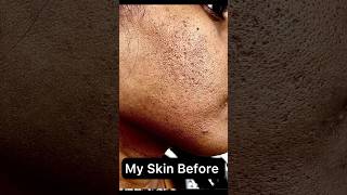 How I cleared my acne amp acne scars ￼in 30 days skincare shorts tretinoin skincareproducts [upl. by Dolph18]