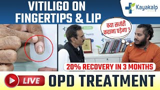 Vitiligo on Lips amp Fingertips  Safed Daag Recovery in 3 Months Cream for vitiligo Kayakalp Global [upl. by Ademordna]