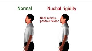 Nuchal rigidity  pathognomonic sign of meningeal irritation [upl. by Aikkin437]