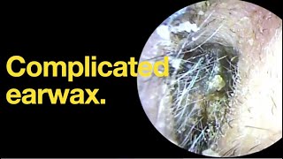 Complicated earwax ear wax removal  ear cleaning  ASMR  relaxation  relax [upl. by Stanhope597]