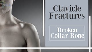 Fractures of the clavicle collarbone fractures [upl. by Nothgiel]