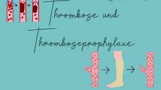 Thromboseprophylaxe Examensfrage [upl. by Audwen]