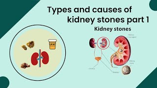 Types and causes of kidney stones part 1 Kidney stone symptoms Kidney stone treatment Kidney diet [upl. by Thapa]