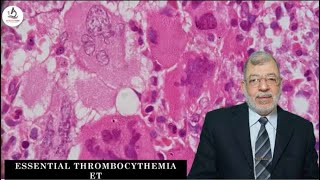 4 Essential Thrombocythemia [upl. by Sagerman160]