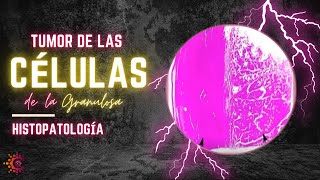 Tumor de las cÃ©lulas de la granulosa  HISTOPATOLOGÃA [upl. by Nameerf16]