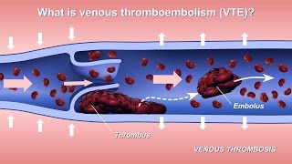 Understanding and Diagnosing Venous Thromboembolism VTE [upl. by Oakes]