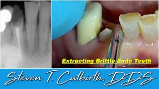 Extracting Brittle Endo Teeth  Dental Minute with Steven T Cutbirth DDS [upl. by Paolo]