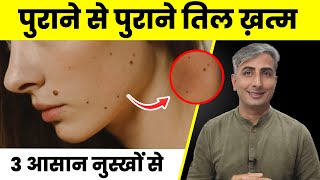 तिल और मस्से बिना लेज़र या सर्जरी जड़ से ख़त्म करें  तिल और मस्से का इलाज  Moles amp Warts Treatment [upl. by Remliw]